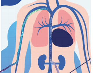 Embolisation des varices pelviennes